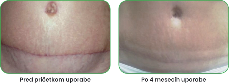 Rezultati uporabe Mepiforma