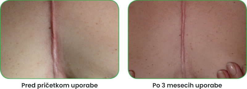 Rezultati uporabe Mepiforma