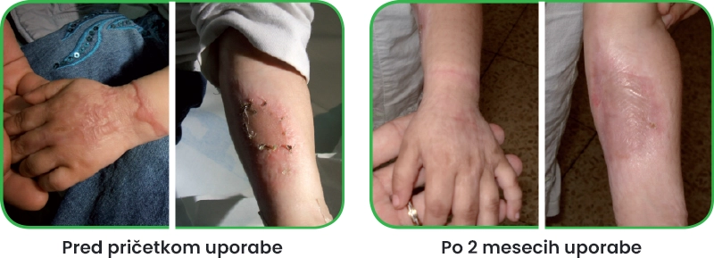 Rezultati uporabe Mepiforma