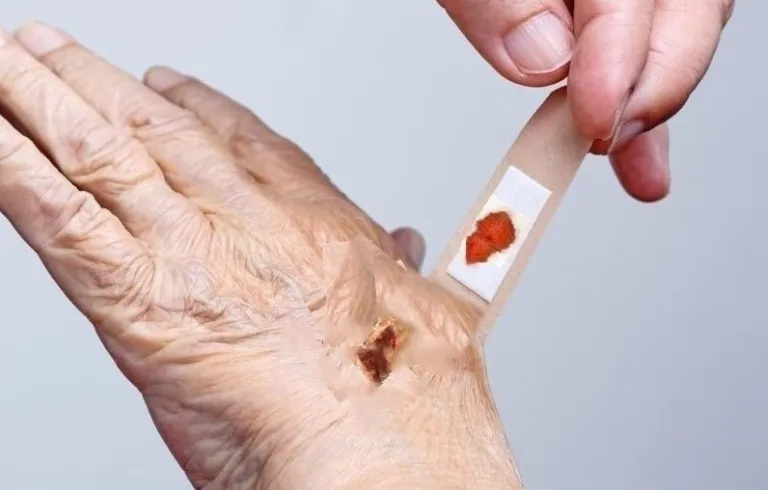 Raztrganine (Skin tears)